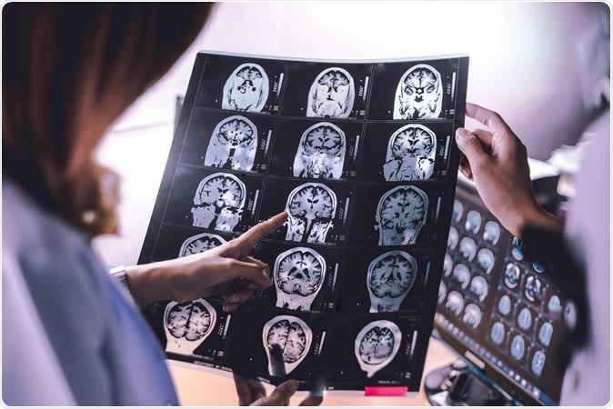 The report demonstrates a clear and urgent need for further research into the prevalence of dementia in people aged under 65, and more specifically, the need for community-based studies to be inclusive of this age group.  Image Credit: Atthapon Raksthaput / Shutterstock