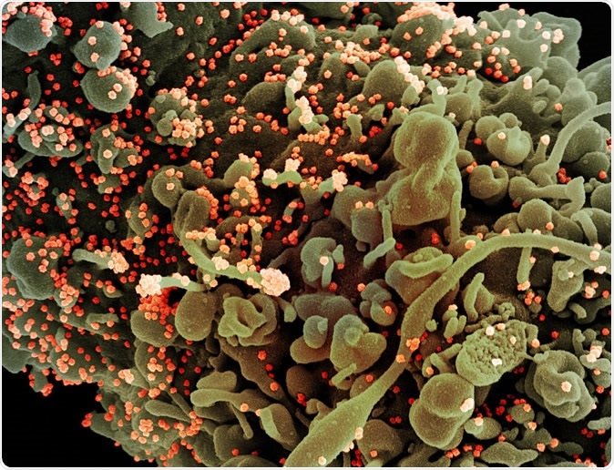 Novel Coronavirus SARS-CoV-2 - Colorized scanning electron micrograph of a cell showing morphological signs of apoptosis, infected with SARS-COV-2 virus particles (orange), isolated from a patient sample. Image captured at the NIAID Integrated Research Facility (IRF) in Fort Detrick, Maryland. Credit: NIAID