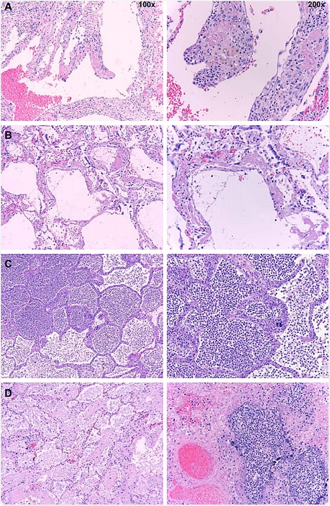 Postmortem histopathology of lungs from COVID-19 patients. Low (100x) and high power (200x) images of lungs from patients who died due to COVID-19. A. Organizing hyaline membranes are seen in the lung which has pre-existing emphysema (100x). Higher power shows fibrin, fibroblasts and mononuclear cells incorporated into the alveolar walls (200x). B. There is diffuse alveolar damage with hyaline membranes lining alveoli (100x). Higher power shows minimal inflammation with only a few mononuclear cells (200x). C. There is extensive intra-alveolar inflammation (neutrophils) in an otherwise normal lung (100x). On higher power, there is minimal alveolar wall thickening by inflammatory cells (also mainly neutrophils on myeloperoxidase staining and only rare lymphocytes) (200x). D. Majority of the sections from this case show organizing intra-alveolar fibrin (100x). Several foci of acute inflammation with alveolar filling are present, as seen here on higher power (200x).