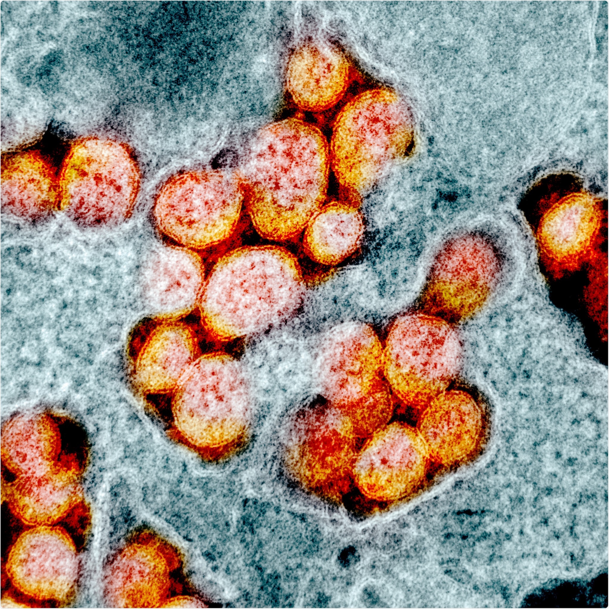 Novel Coronavirus SARS-CoV-2 Transmission electron micrograph of SARS-CoV-2 virus particles, isolated from a patient. Image captured and color-enhanced at the NIAID Integrated Research Facility (IRF) in Fort Detrick, Maryland. Credit: NIAID