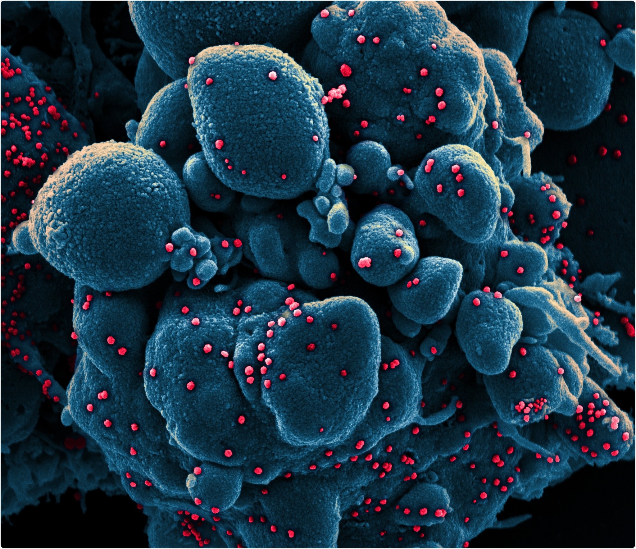 Novel Coronavirus SARS-CoV-2 Colorized scanning electron micrograph of an apoptotic cell (blue) infected with SARS-COV-2 virus particles (red), isolated from a patient sample. Image captured at the NIAID Integrated Research Facility (IRF) in Fort Detrick, Maryland. Credit: NIAID