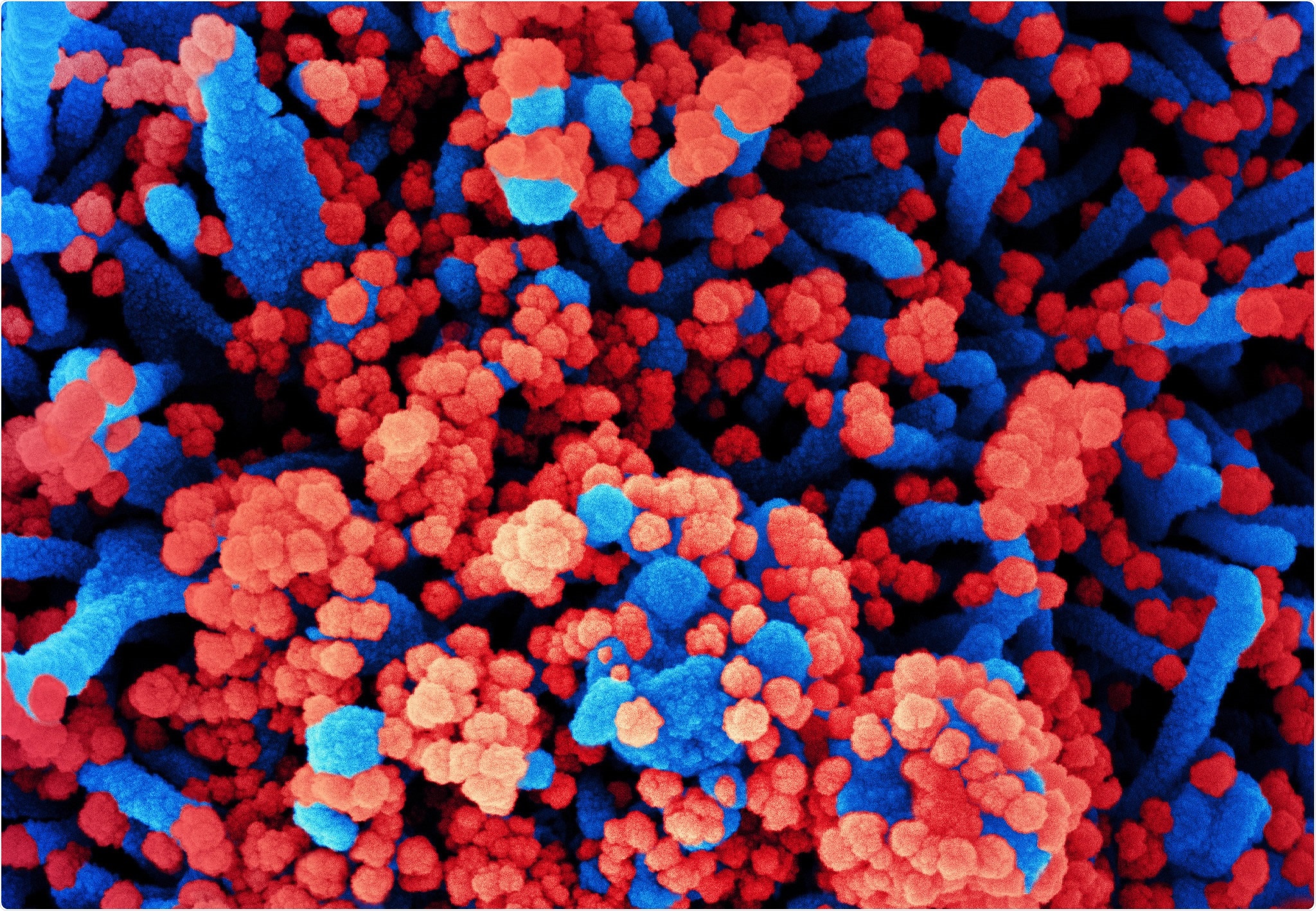 Colorized scanning electron micrograph of a cell (blue) heavily infected with SARS-CoV-2 virus particles (red), isolated from a patient sample. Image captured at the NIAID Integrated Research Facility (IRF) in Fort Detrick, Maryland. Credit: NIAID
