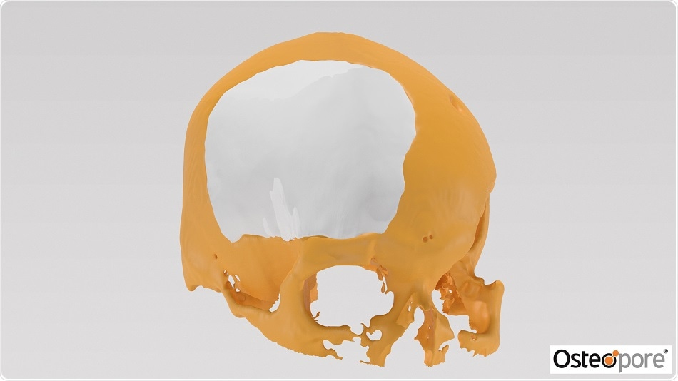 Osteopore announces success of its 3D-printed PCL bone implant in cranioplasty procedure