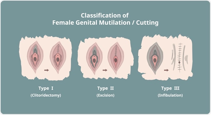 Types of FGM