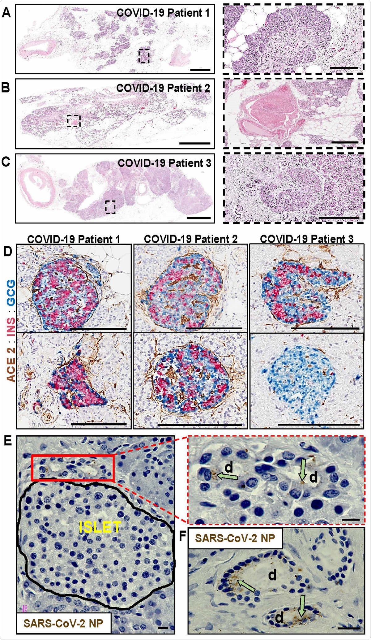 Pathological changes in pancreata of COVID-19 patients. (A) Pancreas tissue section from COVID-19 Patient 1 stained for H&E. Inset highlights fibrotic center with residual acinar cells and islet surrounding ductules. Scale bars: 3mm, inset 200µm. (B) Pancreas tissue section from COVID-19 Patient 2 stained for H&E. Inset highlights microthrombus without adjacent hemorrhages. Scale bars: 4mm, inset 400µm. (C) Pancreas tissue section of COVID-19 Patient 3 stained for H&E. Inset highlights a large, irregularly shaped pancreatic islet surrounded by fibrotic tissue. Scale bars: 4 mm, inset 200µm. (D) Representative pancreas tissue sections from three COVID-19 patients stained for ACE2, insulin (INS) and glucagon (GCG). Scale bars: 200µm. (E) SARS-CoV-2 NP observed in intralobular ducts (d) near an islet in the pancreas of COVID19 Patient 1. Scale bars: 10µm. (F) Representative image of multiple ducts showing SARS-CoV-2 NP positivity in the pancreas of COVID-19 Patient 1. Scale bar: 20µm.