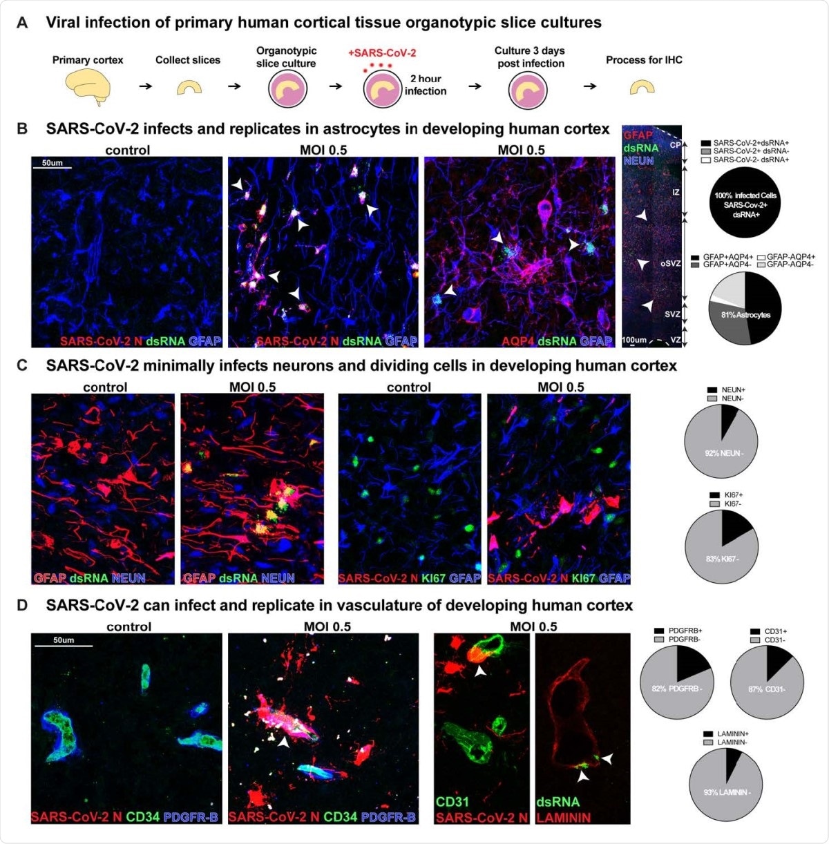 SARS-CoV-2 Infects Astrocytes in Developing Human Cortex. A) Experimental paradigm for viral infection of human cortical tissue. Primary cortical tissue was acutely sectioned and cultured at the air-liquid interface. The next day tissue was infected with SARS-CoV-2 at MOI 0.5 and cultured for 72 hours before being collected and processed. B) SARS-CoV-2 infects GFAP+AQP4+ astrocyte cells in the developing human cortex, which are predominantly located in the subventricular zone (SVZ), where />81% of cells assayed expressed markers of astrocytes. 100% of infected cells expressed both SARS-CoV-2+ nucleocapsid (N) antibody and double-stranded (ds)RNA antibody. White arrowheads indicate dsRNA+GFAP+ infected astrocytes (dsRNA+SARS-CoV-2 N+