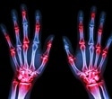 Immune molecule found to play a key role in regulating inflammation in rheumatoid arthritis