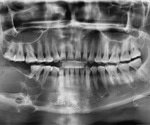 What is Ameloblastoma?