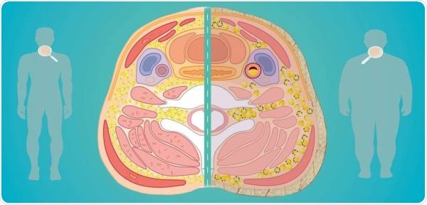 Accumulation of fatty tissue in the neck predicts adiposity, heart problems