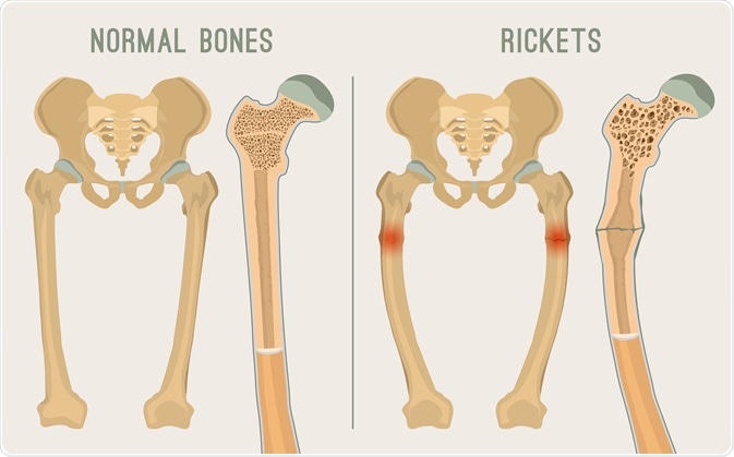 rickets