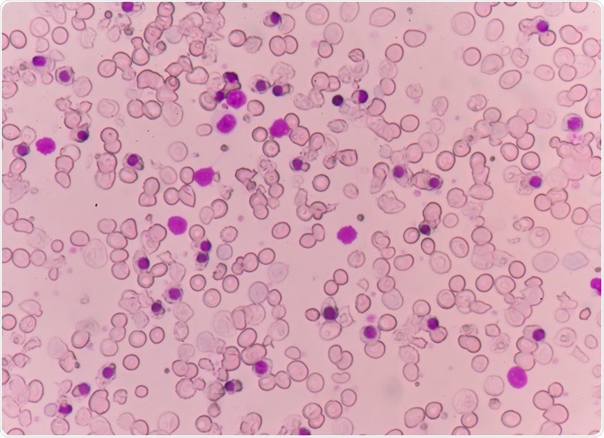 thalassemia