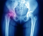 Slipped Capital Femoral Epiphysis (SCFE) Diagnosis