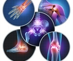 Osteoarthritis Treatments