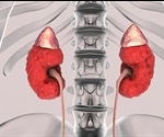 The pressure is on to diagnose and treat chronic kidney disease
