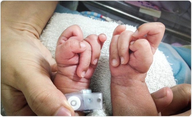 Clenched hand with overlapping fingers characteristically seen in Edwards syndrome. Image Credit: Chalie Chulapornsiri / Shutterstock