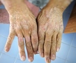 What is Scleroderma?