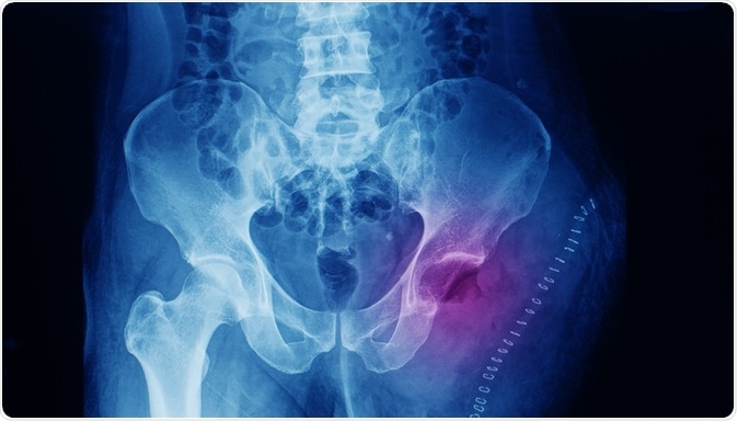 Pelvis x-ray of a patient that has osteosarcoma at the thigh. The patient underwent left side hip disarticulation and wide excision of the tumor. Image Credit:  Yok_onepiece / Shutterstock