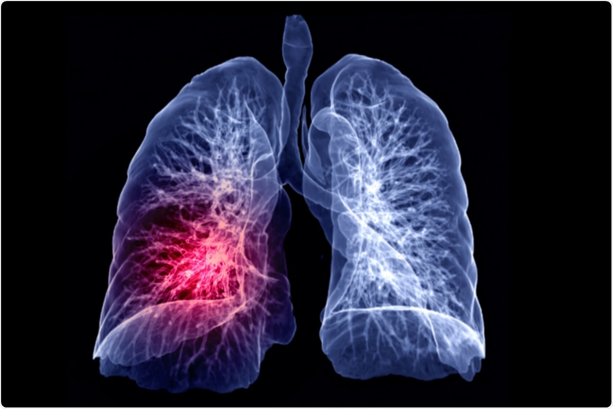 Study: Endotracheal application of ultraviolet A light in critically ill severe acute respiratory syndrome coronavirus-2 patients: A first-in-human study. Image Credit: samunella / Shutterstock