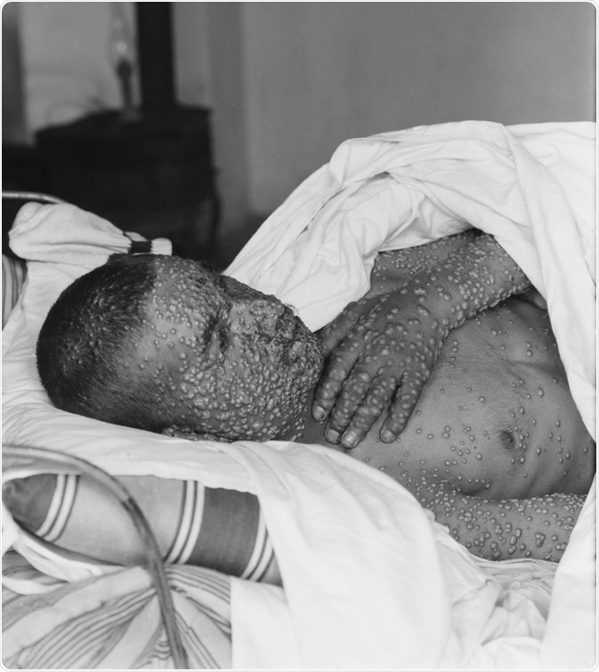 The heavily pockmarked face, arms and hands of a smallpox victim in Palestine, ca. 1900-1925. Image Credit: Everett Collection / Shutterstock