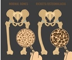 Rickets Diagnosis