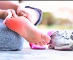 Plantar Fasciitis Treatment