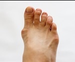 Gout: an Overview