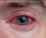 Blepharitis Types and Causes