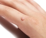 Wart Treatments
