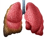 What is Mesothelioma?