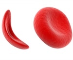Sickle-Cell Disease History