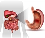 Peptic Ulcer Diagnosis