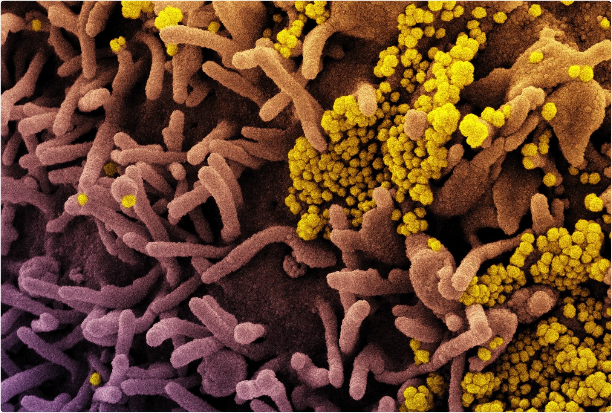 Study: Plasma zinc status and hyperinflammatory syndrome in hospitalized COVID-19 patients. Image Credit: NIAID