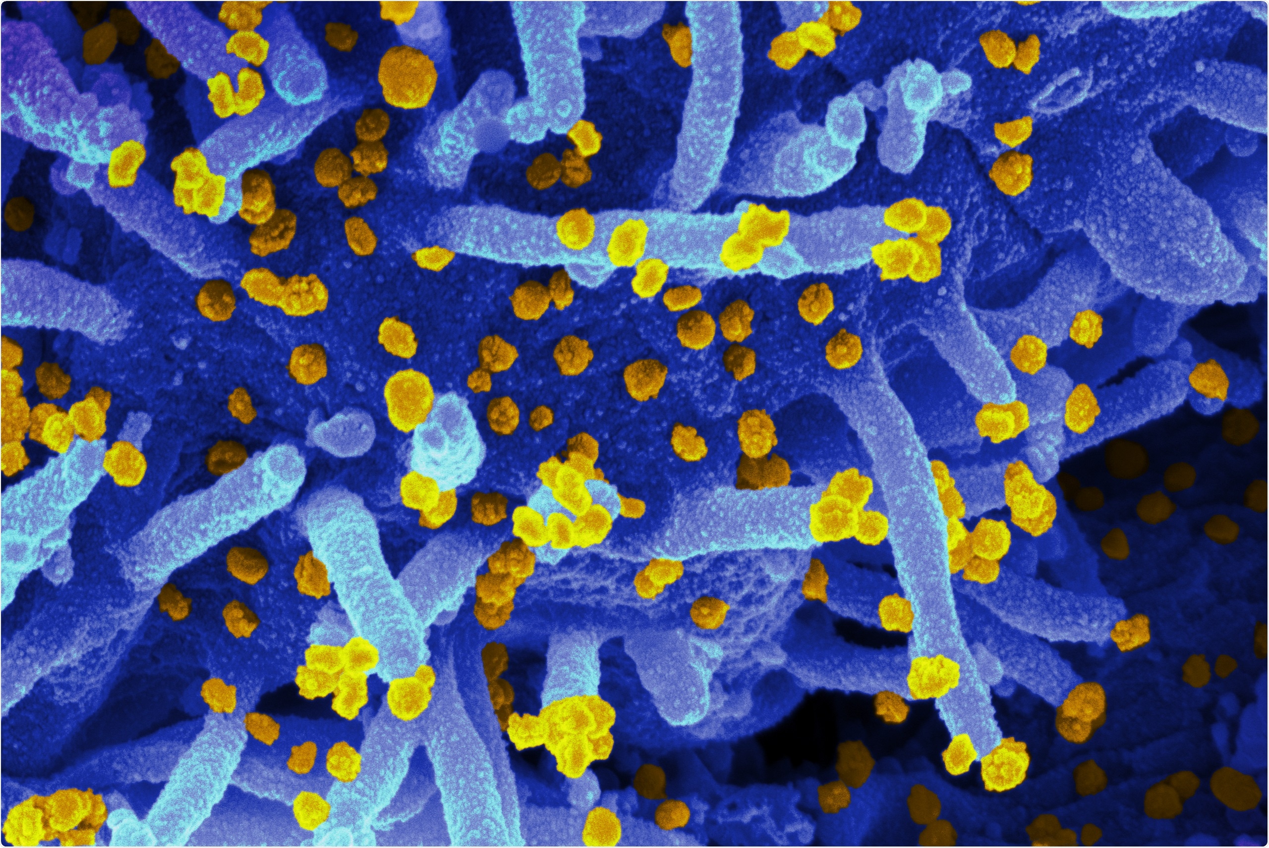 Study: SARS-CoV-2 lineage B.1.1.7 is associated with greater disease severity among hospitalised women but not men. Image Credit: NIAID