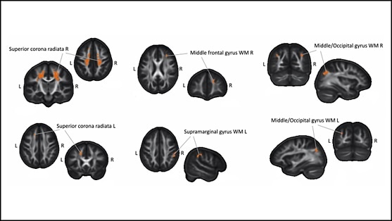 Study shows how learning Braille alters brain structure over time
