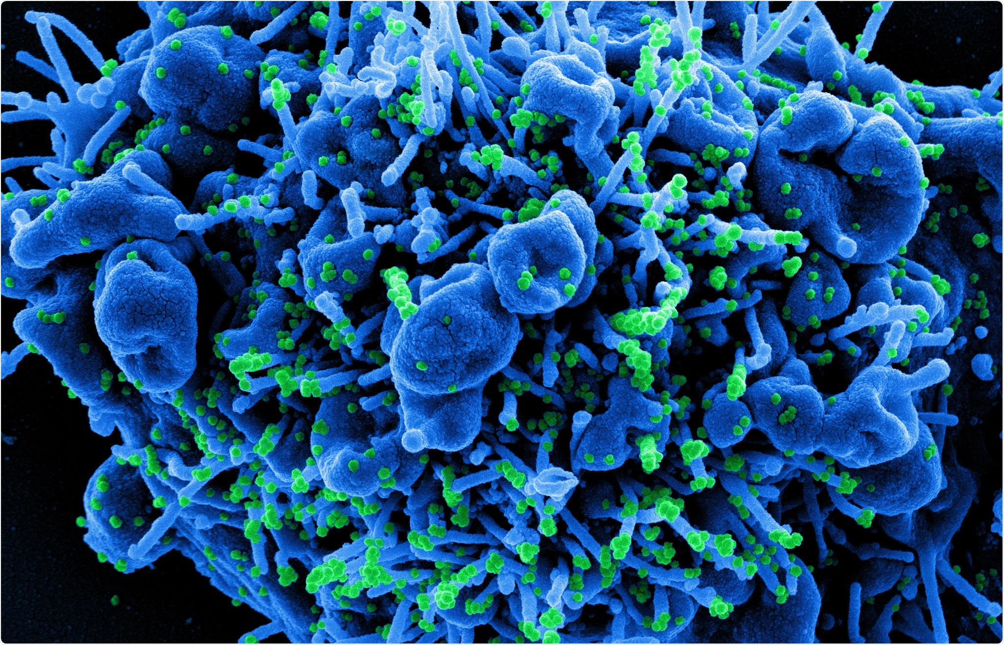 Study: HIF1alpha Cardioprotection in COVID-19 Patients. Image Credit: NIAID