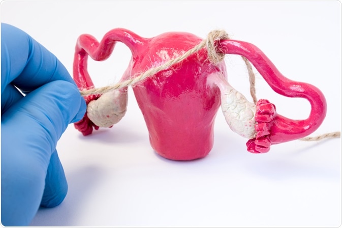 Tubal ligation demonstration