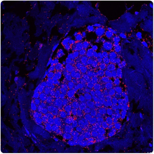 Study provides key information about the mechanism of breast cancer progression