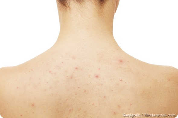 back acne