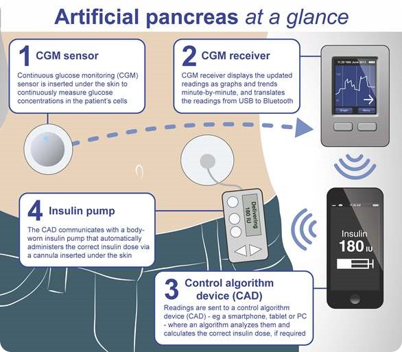 Artificial pancreas