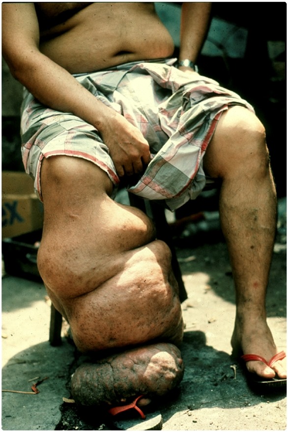 Elephantiasis