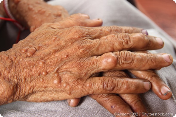 Female hands neurofibromatosis