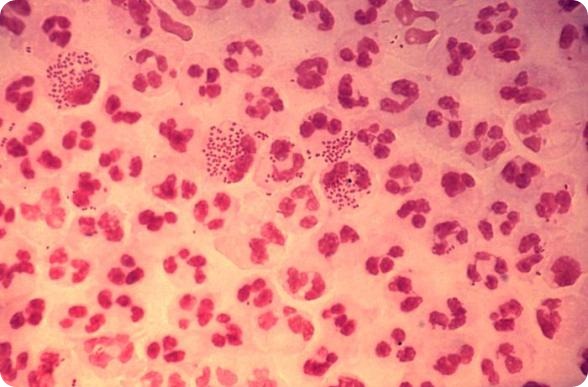 This photomicrograph reveals the histopathology in an acute case of gonococcal urethritis using Gram-stain technique.