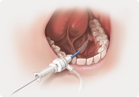 Introducer_Sialendoscopy Image jpg jpg jpg