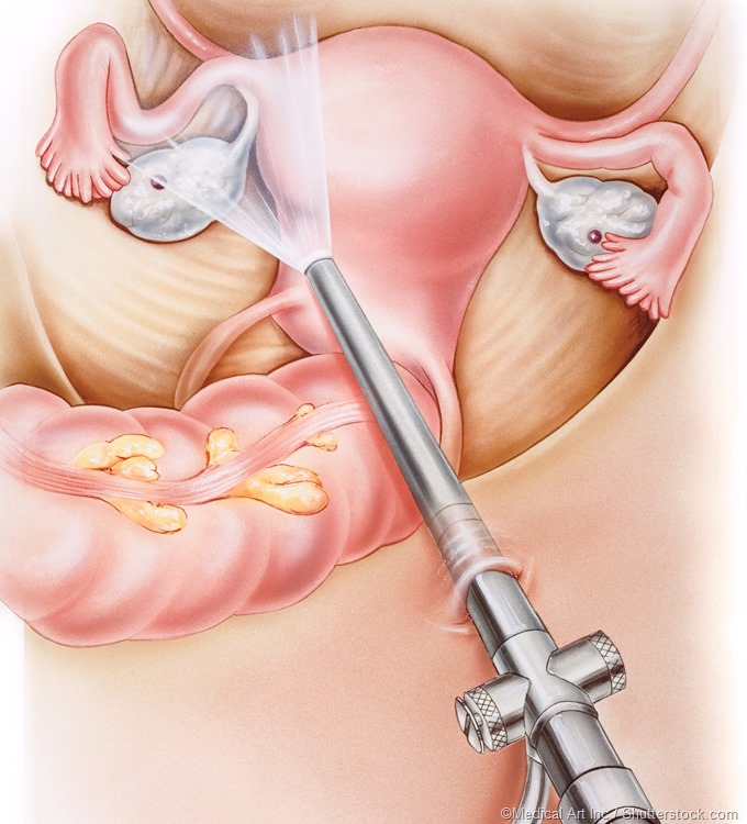Laparoscopy illustration