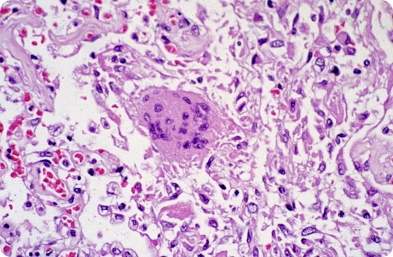 This photomicrograph reveals lung tissue pathology due to SARS.