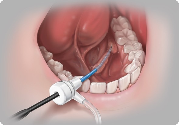 Salivary Duct Access Product jpg resized