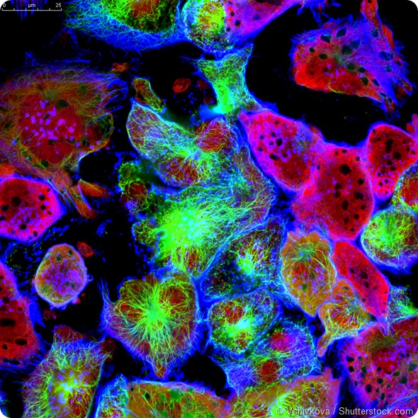Tumor cells under microscope labeled with fluorescent molecules
