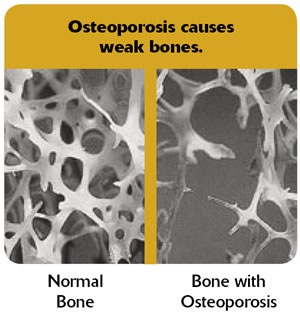 Osteoporosis