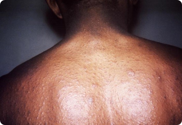 pityriasis rosea