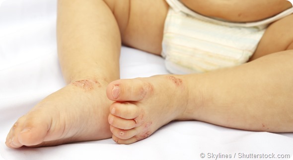 baby eczema